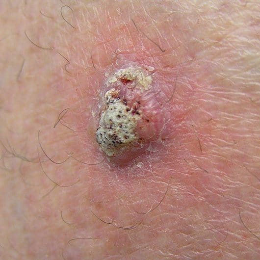 Squamous Cell Carcinoma On Leg