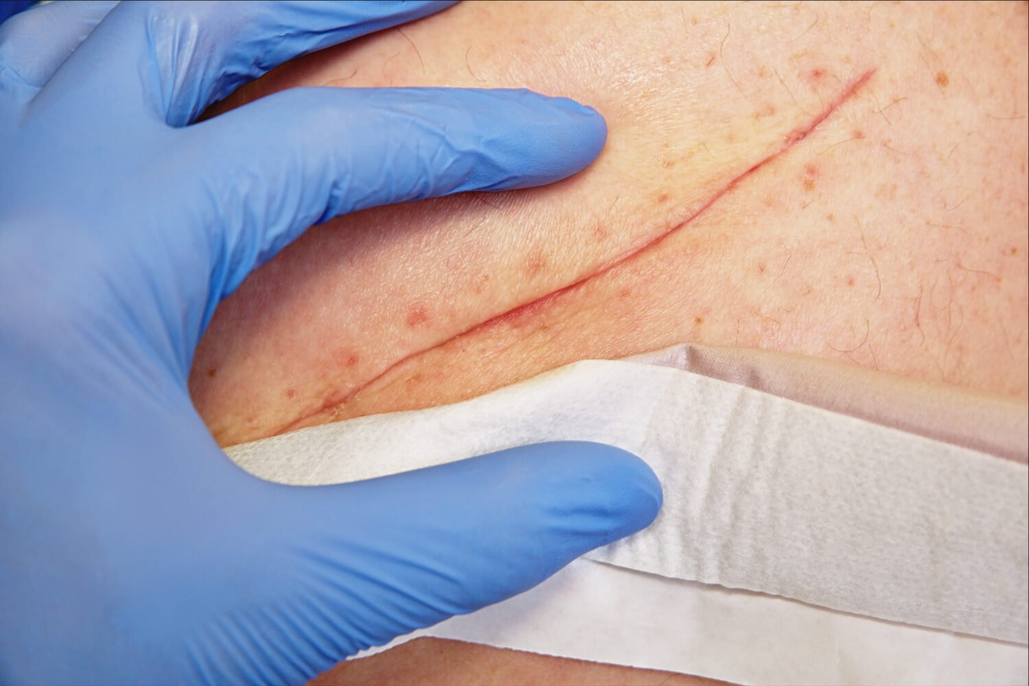 Wound Care – Queensland Skin Cancer Clinic