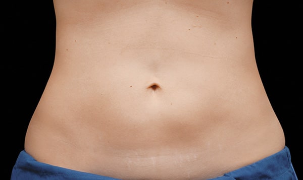 fat freezing abdomen